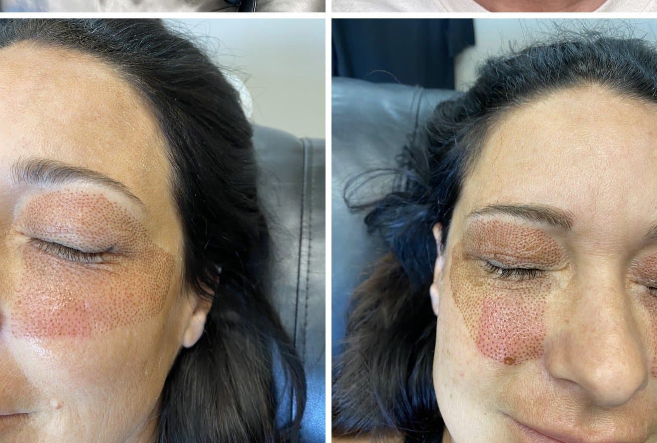 Plasma fibroblast under-eye treatment showing the grid of healing dots, two angles